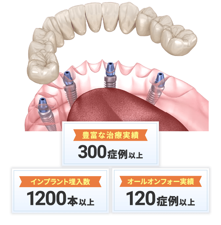 豊富な治療実績 300症例以上 インプラント埋入数 1200本以上 オールフォーワン実績 120症例以上